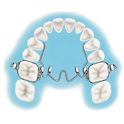 NAOL Nitanium Palatal Expander, 28mm