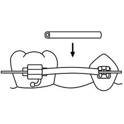 NAOL Clear Tissue Guard, .045 - 10' Spool